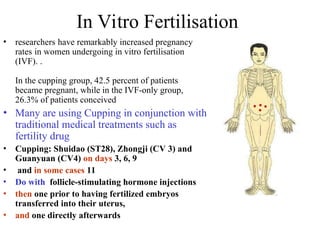 In Vitro Fertilisation
• researchers have remarkably increased pregnancy
rates in women undergoing in vitro fertilisation
(IVF). .
In the cupping group, 42.5 percent of patients
became pregnant, while in the IVF-only group,
26.3% of patients conceived
• Many are using Cupping in conjunction with
traditional medical treatments such as
fertility drug
• Cupping: Shuidao (ST28), Zhongji (CV 3) and
Guanyuan (CV4) on days 3, 6, 9
• and in some cases 11
• Do with follicle-stimulating hormone injections
• then one prior to having fertilized embryos
transferred into their uterus,
• and one directly afterwards
 