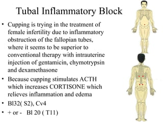Tubal Inflammatory Block
• Cupping is trying in the treatment of
female infertility due to inflammatory
obstruction of the fallopian tubes,
where it seems to be superior to
conventional therapy with intrauterine
injection of gentamicin, chymotrypsin
and dexamethasone
• Because cupping stimulates ACTH
which increases CORTISONE which
relieves inflammation and edema
• Bl32( S2), Cv4
• + or - Bl 20 ( T11)
 