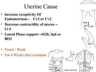 Uterine Cause
• Increase receptivity Of
Endometrium-- Cv3 or Cv2
• Decrease contractility of uterus --
Li 4
• Luteal Phase support –St28, Sp6 or
Bl32
• Twice / Week
• For 4 Weeks after ovulation
 