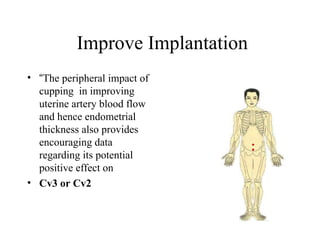 Improve Implantation
• “The peripheral impact of
cupping in improving
uterine artery blood flow
and hence endometrial
thickness also provides
encouraging data
regarding its potential
positive effect on
• Cv3 or Cv2
 