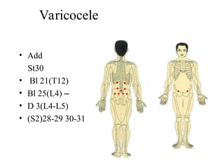 Varicocele
• Add
St30
• Bl 21(T12)
• Bl 25(L4) –
• D 3(L4-L5)
• (S2)28-29 30-31
 