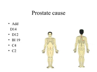 Prostate cause
• Add
D14
• D12
• Bl 19
• C4
• C2
 