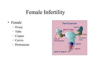 Female Infertility
• Female
– Ovary
– Tube
– Corpus
– Cervix
– Peritoneum
 