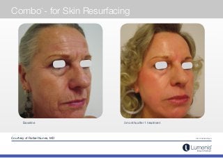 PB-1002909 Rev C
3 months after 1 treatmentBaseline
Courtesy of Rafael Nunes, MD
Combo
TM
- for Skin Resurfacing
 