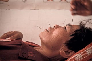 Safety in acupuncture