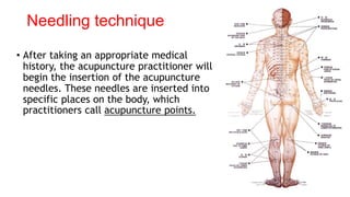 Needling technique
• After taking an appropriate medical
history, the acupuncture practitioner will
begin the insertion of the acupuncture
needles. These needles are inserted into
specific places on the body, which
practitioners call acupuncture points.
 