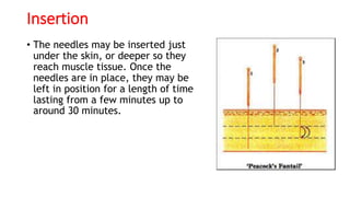 Insertion
• The needles may be inserted just
under the skin, or deeper so they
reach muscle tissue. Once the
needles are in place, they may be
left in position for a length of time
lasting from a few minutes up to
around 30 minutes.
 