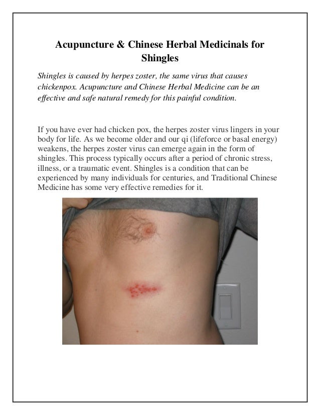 Acupuncture and chinese herbal medicinals for shingles