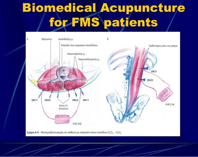 Acupuncture for fibromyalgia