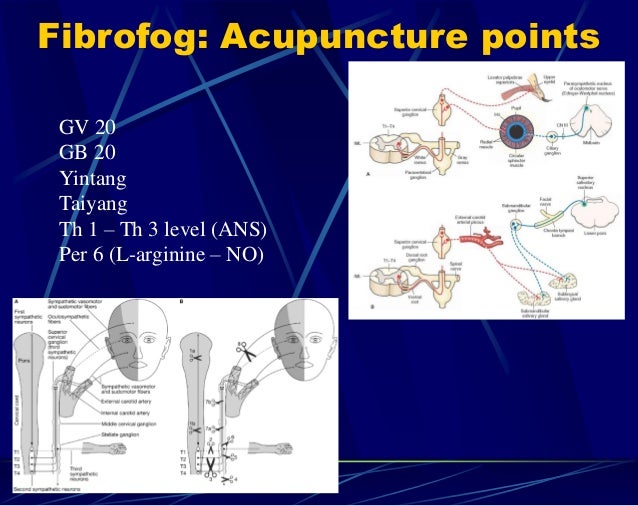 Acupuncture for fibromyalgia