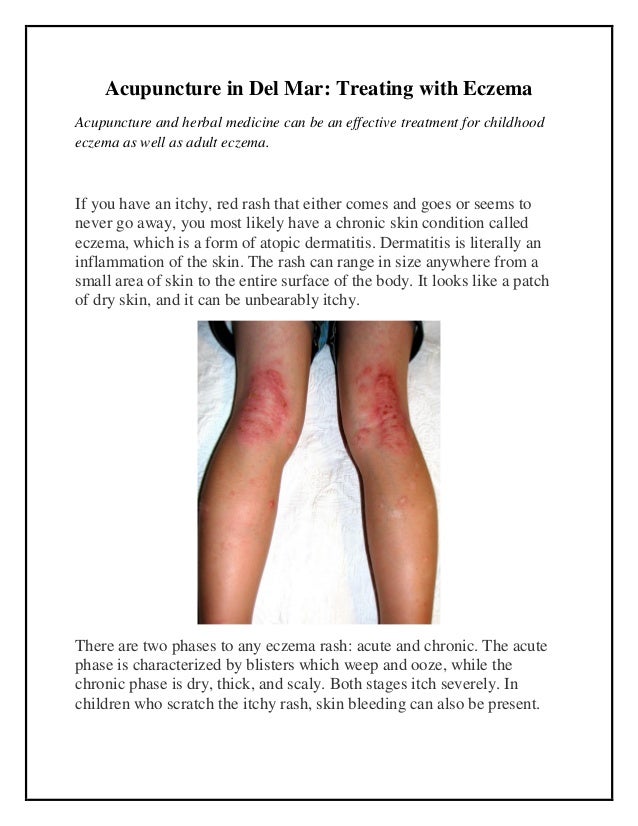 Acupuncture in del mar treating with eczema