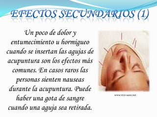 Efectos secundarios (1)Un poco de dolor y entumecimiento u hormigueo cuando se insertan las agujas de acupuntura son los efectos más comunes. En casos raros las personas sienten nauseas durante la acupuntura. Puede haber una gota de sangre cuando una aguja sea retirada. www.vivir-sano.net