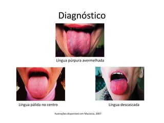 Diagnóstico
Lí
Língua púrpura avermelhada
Língua pálida no centro Língua descascada
Ilustrações disponíveis em Maciocia, 2007
 
