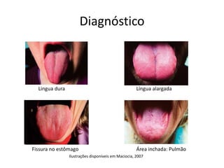 Diagnóstico
Lingua dura Língua alargada
Fissura no estômago Área inchada: Pulmão
Ilustrações disponíveis em Maciocia, 2007
 