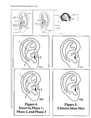 CURSO DE ACUPUNTURA AURICULAR – KOJJI 11
 