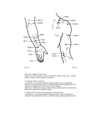 Fig. 44 Fig. 45
Aplicação: agulhar 0,3-0,5 tsun.
Indicações: dor no punho; excesso de pêlo na mulher; boca seca; diabete
melito; malária; vômito durante a gravidez.
5. Waiguan (TA5): ponto Lo
Localização: 2 tsun acima da dobra dorsal do punho, entre os tendões do
músculo extensor digital comum e o músculo dígito quinto-próprio (Fig. 44).
Aplicação: agulhar 0,5-1 tsun; moxa, 10-15 minutos.
Indicações: Cefaléia; dor na nuca; dor no braço; adormecimento e paralisia dos
dedos; dor intercostal; zumbido; surdez.
6. Zhigou (TA6): ponto Jing, pertence ao elemento Fogo
Localização:  tsun acima do ponto Waiguan (TA5), entre os tendões do
músculo extensor digital comum e o músculo dígito quinto-próprio (Fig. 44).
 