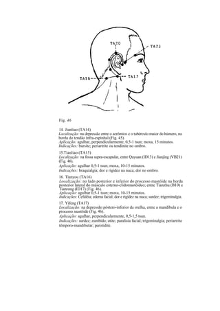 Fig. 46
14. Jianliao (TA14)
Localização: na depressão entre o acrômico e o tubérculo maior do húmero, na
borda do tendão infra-espinhal (Fig. 45).
Aplicação: agulhar, perpendicularmente, 0,5-1 tsun; moxa, 15 minutos.
Indicações: bursite; periartrite ou tendinite no ombro.
15.Tianliao (TA15)
Localização: na fossa supra-escapular, entre Quyuan (ID13) e Jianjing (VB21)
(Fig. 46).
Aplicação: agulhar 0,5-1 tsun; moxa, 10-15 minutos.
Indicações: braquialgia; dor e rigidez na nuca; dor no ombro.
16. Tianyou (TA16)
Localização: no lado posterior e inferior do processo mastóide na borda
posterior lateral do músculo esterno-clidomastóideo; entre Tianzhu (B10) e
Tianrong (ID17) (Fig. 46).
Aplicação: agulhar 0,5-1 tsun; moxa, 10-15 minutos.
Indicações: Cefaléia; edema facial; dor e rigidez na nuca; surdez; trigeminalgia.
17. Yifeng (TA17)
Localização: na depressão póstero-inferior da orelha, entre a mandíbula e o
processo mastóide (Fig. 46).
Aplicação: agulhar, perpendicularmente, 0,5-1,5 tsun.
Indicações: surdez; zumbido; otite; paralisia facial; trigeminalgia; periartrite
têmporo-mandibular; parotidite.
 