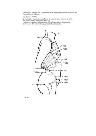 Indicações: tontura; dor e rigidez na nuca; braquialgia; mastite; paralisia no
braço; hipertiroidismo.
22. Yuanye (VB22)
Localização: 3 tsun abaixo da borda da axila, na linha anterior da axila,
no quarto espaço intercostal (Fig. 49).
Aplicação: agulhar, obliquamente, 0,3-0,5 tsun; moxa, 10 minutos.
Indicações: dor intercostal; pleurite; linfadenite axilar.
Fig. 49
 