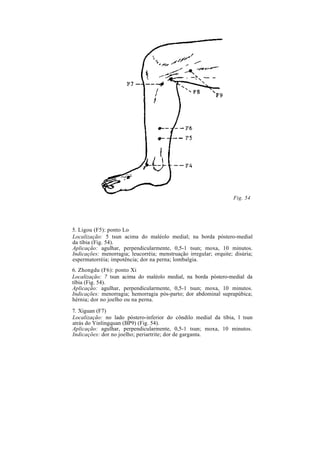 Fig. 54
5. Ligou (F5): ponto Lo
Localização: 5 tsun acima do maléolo medial; na borda póstero-medial
da tíbia (Fig. 54).
Aplicação: agulhar, perpendicularmente, 0,5-1 tsun; moxa, 10 minutos.
Indicações: menorragia; leucorréia; menstruação irregular; orquite; disúria;
espermatorréia; impotência; dor na perna; lombalgia.
6. Zhongdu (F6): ponto Xi
Localização: 7 tsun acima do maléolo medial, na borda póstero-medial da
tíbia (Fig. 54).
Aplicação: agulhar, perpendicularmente, 0,5-1 tsun; moxa, 10 minutos.
Indicações: menorragia; hemorragia pós-parto; dor abdominal suprapúbica;
hérnia; dor no joelho ou na perna.
7. Xiguan (F7)
Localização: no lado póstero-inferior do côndilo medial da tíbia, l tsun
atrás do Yinlingquan (BP9) (Fig. 54).
Aplicação: agulhar, perpendicularmente, 0,5-1 tsun; moxa, 10 minutos.
Indicações: dor no joelho; periartrite; dor de garganta.
 