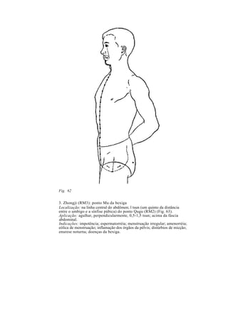 Fig. 62
3. Zhongji (RM3): ponto Mu da bexiga
Localização: na linha central do abdômen; l tsun (um quinto da distância
entre o umbigo e a sínfise púbica) do ponto Qugu (RM2) (Fig. 63).
Aplicação: agulhar, perpendicularmente, 0,5-1,5 tsun; acima da fáscia
abdominal.
Indicações: impotência; espermatorréia; menstruação irregular; amenorréia;
eólica de menstruação; inflamação dos órgãos da pélvis; distúrbios de micção;
enurese noturna; doenças da bexiga.
 