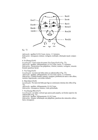 Kg. 72
Aplicação: agulhar 0,2-0,3 tsun; moxa, 1-3 minutos.
Indicações: enxaqueca; tontura; vertigem; resfriado; obstrução nasal; conjun-
tivite.
4. Er-Zhung (Ext4)
Localização: l tsun acima do ponto Yin-Tang (Ext5) (Fig. 72).
Aplicação: agulhar, obliquamente, 0,1-0,2 tsun; moxa, 1-3 minutos.
Indicações: furunculose nas pálpebras; vômito; tontura; vertigem; sinusite
frontal; paralisia facial.
5. Yin-Tang (Ext5)
Localização: no meio da linha entre as sobrancelhas (Fig. 72).
Aplicação: agulhar, obliquamente, 0,1-0,2 tsun; moxa, 1-2 minutos.
Indicações: Cefaléia frontal; tontura; vertigem; problema do nariz e dos olhos;
insônia; hipertensão; convulsão infantil.
6. Shan-Quen (Ext6)
Localização: No meio da linha que liga as comissuras internas dos olhos (Fig.
72).
Aplicação: agulhar, obliquamente, 0,1-0,2 tsun.
Indicações: enxaqueca; tontura; visão perturbada.
7. Tou-Kuang-Min (Ext7)
Localização: na linha vertical que passa pela pupila, na borda superior da
sobrancelha (Fig. 72).
Aplicação: agulhar, obliquamente, 0,1-0,3 tsun.
Indicações: miopia; inflamação nas pálpebras; paralisia dos músculos orbicu-
lares; enxaqueca.
 