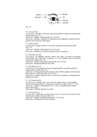 Fig. 73
8. Yu-Yao (Ext8)
Localização: na linha vertical que passa pela pupila, na depressão mediana da
sobrancelha (Fig. 72).
Aplicação: agulhar, obliquamente, 0,1-0,3 tsun.
Indicações: pterígio; conjuntivite; furunculose nas pálpebras; paralisia facial;
paralisia dos músculos orbiculares.
9. Yu-Wei (Ext9)
Localização: no lado externo, 0,1 tsun das comissuras externas dos olhos
(Fig. 73).
Aplicação: agulhar, obliquamente, 0,1-0,3 tsun.
Indicações: problema nos olhos; paralisia facial; enxaqueca.
10. Chiu-Hou (Ext10)
Localização: na pálpebra inferior, abaixo dos olhos, na borda da margem
infra-orbital das comissuras externas, a 1/4 de distância das comissuras
externas dos olhos (Fig. 73).
Aplicação: agulhar, pela borda infra-orbital, 0,5-1,5 tsun.
Indicação: qualquer problema nos olhos.
11. Jien-Min (Ext11)
Localização: 0,4 tsun abaixo do ponto Jingming (B1), na borda medial da
margem infra-orbital (Fig. 73).
Aplicação: ao longo da borda da margem infra-orbital; agulhar, na direção do
lado inferior e medial do olho, 0,5-1,5 tsun.
Indicações: catarata; atrofia do nervo ótico; rinite; estrabismo; inflamação da
glândula lacrimal.
12. Tai-Yang (Extl2)
Localização: na depressão, l tsun atrás do espaço entre a extremidade
externa da sobrancelha e as comissuras externas dos olhos (Figs. 72 e 74).
Aplicação: agulhar, obliquamente, 0,5-1 tsun, ou agulhar para sangrar
uma a duas gotas.
Indicações: Cefaléia; doenças nos olhos.
13. Er-Jian (Ext13)
Localização: dobrando a orelha para a frente, o ponto fica na parte mais
saliente do pavilhão auricular (Fig. 74).
Aplicação: agulhar, perpendicularmente, 0,1-0,2 tsun.
Indicações: enxaqueca; tracoma; pterígio.
 