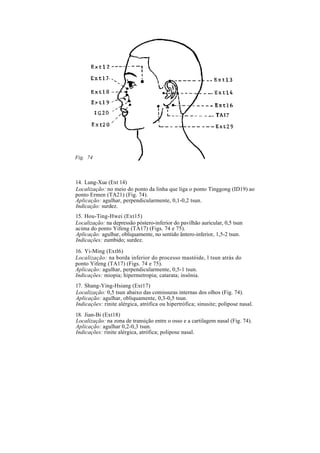 14. Lung-Xue (Ext 14)
Localização: no meio do ponto da linha que liga o ponto Tinggong (ID19) ao
ponto Ermen (TA21) (Fig. 74).
Aplicação: agulhar, perpendicularmente, 0,1-0,2 tsun.
Indicação: surdez.
15. Hou-Ting-Hwei (Ext15)
Localização: na depressão póstero-inferior do pavilhão auricular, 0,5 tsun
acima do ponto Yifeng (TA17) (Figs. 74 e 75).
Aplicação: agulhar, obliquamente, no sentido ântero-inferior, 1,5-2 tsun.
Indicações: zumbido; surdez.
16. Yi-Ming (Extl6)
Localização: na borda inferior do processo mastóide, l tsun atrás do
ponto Yifeng (TA17) (Figs. 74 e 75).
Aplicação: agulhar, perpendicularmente, 0,5-1 tsun.
Indicações: miopia; hipermetropia; catarata; insônia.
17. Shang-Ying-Hsiang (Ext17)
Localização: 0,5 tsun abaixo das comissuras internas dos olhos (Fig. 74).
Aplicação: agulhar, obliquamente, 0,3-0,5 tsun.
Indicações: rinite alérgica, atrófica ou hipertrófica; sinusite; polipose nasal.
18. Jian-Bi (Ext18)
Localização: na zona de transição entre o osso e a cartilagem nasal (Fig. 74).
Aplicação: agulhar 0,2-0,3 tsun.
Indicações: rinite alérgica, atrófica; polipose nasal.
Fig. 74
 