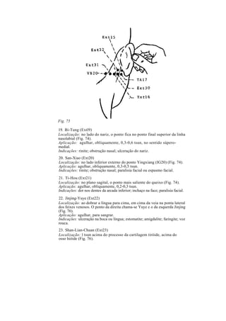 Fig. 75
19. Bi-Tung (Extl9)
Localização: no lado do nariz, o ponto fica no ponto final superior da linha
nasolabial (Fig. 74).
Aplicação: agulhar, obliquamente, 0,3-0,6 tsun, no sentido súpero-
medial.
Indicações: rinite; obstrução nasal; ulceração do nariz.
20. San-Xiao (Ext20)
Localização: no lado inferior externo do ponto Yingxiang (IG20) (Fig. 74).
Aplicação: agulhar, obliquamente, 0,3-0,5 tsun.
Indicações: rinite; obstrução nasal; paralisia facial ou espasmo facial.
21. Ti-Hou (Ext21)
Localização: no plano sagital, o ponto mais saliente do queixo (Fig. 74).
Aplicação: agulhar, obliquamente, 0,2-0,3 tsun.
Indicações: dor nos dentes da arcada inferior; inchaço na face; paralisia facial.
22. Jinjing-Yuye (Ext22)
Localização: ao dobrar a língua para cima, em cima da veia na ponta lateral
dos feixes venosos. O ponto da direita chama-se Yuye e o da esquerda Jinjing
(Fig. 76).
Aplicação: agulhar, para sangrar.
Indicações: ulceração na boca ou língua; estomatite; amigdalite; faringite; voz
rouca.
23. Shan-Lian-Chuan (Ext23)
Localização: l tsun acima do processo da cartilagem tiróide, acima do
osso hióide (Fig. 76).
 