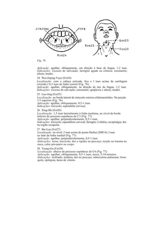 Fig. 76
Aplicação: agulhar, obliquamente, em direção à base da língua, 1-2 tsun.
Indicações: excesso de salivação; laringite aguda ou crônica; estomatite;
afasia; mudez.
24. Wai-Jinjing-Yuye (Ext24)
Localização: com a cabeça esticada, fica a l tsun acima da cartilagem
cricóide e 0,3 tsun da linha central (Fig. 76).
Aplicação: agulhar, obliquamente, na direção da raiz da língua, 1-2 tsun.
Indicações: excesso de salivação; estomatite; apoplexia e afasia; mudez.
25. Luo-Jing (Ext25)
Localização: na borda lateral do músculo esterno-clidomastóideo. Na porção
1/3 superior (Fig. 76).
Aplicação: agulhar, obliquamente, 0,5-1 tsun.
Indicações- torcicolo; espondilite cervical.
26. Xing-Shi (Ext26)
Localização: 1,5 tsun lateralmente à linha mediana, no nível da borda
inferior do processo espinhoso do C3 (Fig. 77).
Aplicação: agulhar, perpendicularmente, 0,5-1 tsun.
Indicações: torcicolo; espondilose cervical; faringite; Cefaléia; occipitalgia; dor
na região escapular.
27. Bai-Lao (Ext27)
Localização: no nível, 2 tsun acima do ponto Dazhui (DM14), l tsun
ao lado da linha medial (Fig. 77).
Aplicação: agulhar, perpendicularmente, 0,5-1 tsun.
Indicações: tosse; torcicolo; dor e rigidez no pescoço; torção ou trauma na
nuca; calor pós-parto no corpo.
28. Tsung-Gu (Ext28)
Localização: abaixo do processo espinhoso do C6 (Fig. 77).
Aplicação: agulhar, obliquamente, 0,5-1 tsun; moxa, 5-10 minutos.
Indicações: resfriado; malária; dor no pescoço; tuberculose pulmonar; bron-
quite; epilepsia; ânsia de vômito.
 