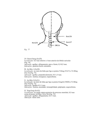 Fig. 77
29. Chian-Cheng (Ext29)
Localização: 0,5 tsun inferior e l tsun anterior do lóbulo auricular
(Fig. 74).
Aplicação: agulhar, obliquamente, para a frente, 0,3-0,5 tsun.
Indicações: paralisia facial; estomatite.
30. An-Min-1 (Ext30)
Localização: no meio da linha que liga os pontos Yifeng (TA17) e Yi-Ming
(Ext 16) (Fig. 75).
Aplicação: agulhar, perpendicularmente, 0,5-1,5 tsun.
Indicações: insônia; enxaqueca; esquizofrenia.
31. An-Min-2 (Ext31)
Localização: no meio da linha que liga os pontos Fengchi (VB20) e Yi-Ming
(Ext 16) (Fig. 75).
Aplicação: agulhar 0,5-1 tsun.
Indicações: insônia; ansiedade; intranqüilidade; palpitação; esquizofrenia.
32. Xing-Feng (Ext32)
Localização: na região súpero-posterior do processo mastóide, 0,5 tsun
acima do ponto An-Min-1 (Ext 30) (Fig. 75).
Aplicação: agulhar, obliquamente, 0,5-1 tsun.
Indicação: muito sono.
 