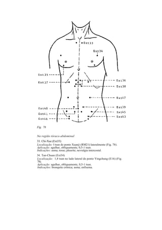 Fig. 78
Na região tóraco-abdominal
33. Chi-Xue (Ext33)
Localização: l tsun do ponto Xuanji (RM21) lateralmente (Fig. 78).
Aplicação: agulhar, obliquamente, 0,5-1 tsun.
Indicações: asma; tosse; pleurite; nevralgia intercostal.
34. Tan-Chuan (Ext34)
Localização: 1,8 tsun no lado lateral do ponto Yingchung (E16) (Fig.
78).
Aplicação: agulhar, obliquamente, 0,5-1 tsun.
Indicações: bronquite crônica; asma; enfisema.
 