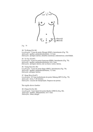 Fig. 79
44. Tsi-Kung (Ext 44)
Localização: 3 tsun do ponto Zhongji (RM3), lateralmente (Fig. 79).
Aplicação: agulhar, perpendicularmente, 1-2 tsun.
Indicações: prolapso uterino; distúrbio menstrual; endometriose; esterilidade.
45. Ti-Tuo (Ext45)
Localização: 4 tsun do ponto Guanyuan (RM4), lateralmente (Fig. 78).
Aplicação: agulhar, perpendicularmente, 0,8-1 tsun.
Indicações: prolapso uterino; dor no baixo ventre; hérnia.
46. Tsung-Jian (Ext 46)
Localização: 3 tsun do ponto Qugu (RM2), lateralmente (Fig. 78).
Aplicação: agulhar, perpendicularmente, 1-2 tsun.
Indicação: prolapso uterino.
47. Heng-Wen (Ext47)
Localização: 0,5 tsun medialmente do ponto Daheng (BP15) (Fig. 78).
Aplicação: moxa, 5-20 minutos.
Indicações: excesso de transpiração; fraqueza nas pernas.
Na região dorso-Iombar
48. Chuan-Xi (Ext 48)
Localização: l tsun lateral do ponto Dazhui (DM14) (Fig. 80).
Aplicação: agulhar, obliquamente, 0,5-1 tsun.
Indicações: asma; alergia.
 