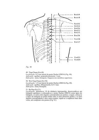 Fig. 80
49. Ting-Chuan (Ext 49)
Localização: 0,5 tsun lateral do ponto Dazhui (DM14) (Fig. 80).
Aplicação: agulhar, perpendicularmente, l tsun.
Indicações: asma; bronquite; fraqueza nos membros superiores.
50. Wai-Ting-Chuan (Ext 50)
Localização: 1,5 tsun lateral do ponto Dazhui (DM14) (Fig. 80).
Aplicação: agulhar, obliquamente, 0,5-1 tsun.
Indicações: asma; bronquite.
51. Ba-Hua (Ext 51)
Localização: delimita-se 1/4 de distância intermamilar, descrevendo-se um
triângulo eqüilátero e colocando-se o ponto Dazhui (DM14) como ápice do
triângulo, os outros dois ângulos correspondem aos pontos; a seguir, coloca-se
o ápice do triângulo no ponto médio entre os dois primeiros pontos, e os dois
ângulos corresponderão a dois outros pontos; repete-se a seqüência mais duas
vezes, até completar oito pontos (Fig. 81).
 