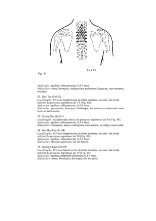 Fig. 81
Aplicação: agulhar, obliquamente, 0,5-1 tsun.
Indicações: asma; bronquite; tuberculose pulmonar; fraqueza; suor noturno;
artralgia.
52. Zhu-Tse (Ext52)
Localização: 0,5 tsun lateralmente da linha mediana, no nível da borda
inferior do processo espinhoso do T3 (Fig. 80).
Aplicação: agulhar, obliquamente, 0,5-1 tsun.
Indicações: pneumonia; bronquite; lombalgia; dor torácica e abdominal resis-
tente ao tratamento.
53. Ju-Jue-Shu (Ext53)
Localização: na depressão abaixo do processo espinhoso do T4 (Fig. 80).
Aplicação: agulhar, obliquamente, 0,5-1 tsun.
Indicações: bronquite; asma; cardiopatia; neurastenia; nevralgia intercostal.
54. Wei-Re-Xue (Ext54)
Localização: 0,5 tsun lateralmente da linha mediana, no nível da borda
inferior do processo espinhoso do T4 (Fig. 80).
Aplicação: agulhar, obliquamente, 0,5-1 tsun.
Indicações: doenças gástricas; dor de dentes.
55. Zhong-Chuan (Ext55)
Localização: 0,5 tsun lateralmente da linha mediana, no nível da borda
inferior do processo espinhoso do T5 (Fig. 80).
Aplicação: agulhar, perpendicularmente, 0,5-1 tsun.
Indicações: asma; bronquite; dorsalgia; dor no peito.
 