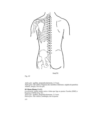 Fig. 83
Aplicação: agulhar, perpendicularmente, 2-3 tsun.
Indicações: dor ciática; fraqueza dos membros inferiores; seqüela de paralisia
infantil; alergia; frio nos pés.
69. Huan-Zhung (Ext69)
Localização: ponto médio entre a linha que liga os pontos Yaoshu (DM2) e
Huantiao (VB30) (Fig. 82).
Aplicação: agulhar, perpendicularmente, 2-3 tsun.
Indicações: dor ciática; lombalgia; dor na perna.
17?
 