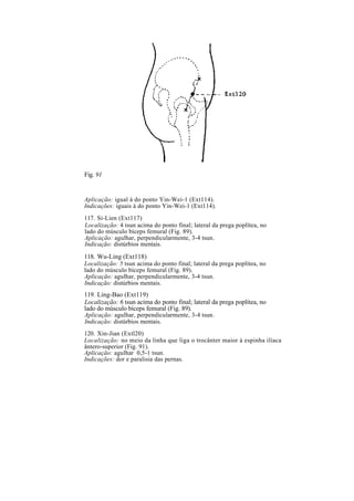 Fig. 91
Aplicação: igual à do ponto Yin-Wei-1 (Ext114).
Indicações: iguais à do ponto Yin-Wei-1 (Ext114).
117. Si-Lien (Ext117)
Localização: 4 tsun acima do ponto final; lateral da prega poplítea, no
lado do músculo bíceps femural (Fig. 89).
Aplicação: agulhar, perpendicularmente, 3-4 tsun.
Indicação: distúrbios mentais.
118. Wu-Ling (Ext118)
Localização: 5 tsun acima do ponto final; lateral da prega poplítea, no
lado do músculo bíceps femural (Fig. 89).
Aplicação: agulhar, perpendicularmente, 3-4 tsun.
Indicação: distúrbios mentais.
119. Ling-Bao (Ext119)
Localização: 6 tsun acima do ponto final; lateral da prega poplítea, no
lado do músculo bíceps femural (Fig. 89).
Aplicação: agulhar, perpendicularmente, 3-4 tsun.
Indicação: distúrbios mentais.
120. Xin-Jian (Extl20)
Localização: no meio da linha que liga o trocânter maior à espinha ilíaca
ântero-superior (Fig. 91).
Aplicação: agulhar 0,5-1 tsun.
Indicações: dor e paralisia das pernas.
 