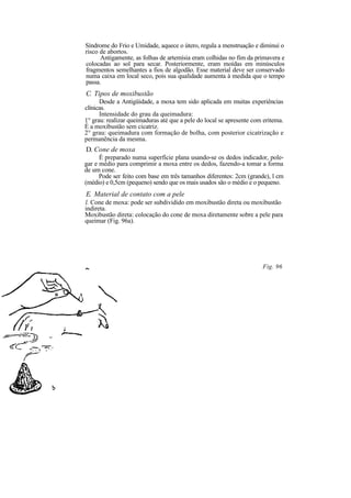 Síndrome do Frio e Umidade, aquece o útero, regula a menstruação e diminui o
risco de abortos.
Antigamente, as folhas de artemísia eram colhidas no fim da primavera e
colocadas ao sol para secar. Posteriormente, eram moídas em minúsculos
fragmentos semelhantes a fios de algodão. Esse material deve ser conservado
numa caixa em local seco, pois sua qualidade aumenta à medida que o tempo
passa.
C. Tipos de moxibustão
Desde a Antigüidade, a moxa tem sido aplicada em muitas experiências
clínicas.
Intensidade do grau da queimadura:
1° grau: realizar queimaduras até que a pele do local se apresente com eritema.
É a moxibustão sem cicatriz.
2° grau: queimadura com formação de bolha, com posterior cicatrização e
permanência da mesma.
D. Cone de moxa
É preparado numa superfície plana usando-se os dedos indicador, pole-
gar e médio para comprimir a moxa entre os dedos, fazendo-a tomar a forma
de um cone.
Pode ser feito com base em três tamanhos diferentes: 2cm (grande), l cm
(médio) e 0,5cm (pequeno) sendo que os mais usados são o médio e o pequeno.
E. Material de contato com a pele
l. Cone de moxa: pode ser subdividido em moxibustão direta ou moxibustão
indireta.
Moxibustão direta: colocação do cone de moxa diretamente sobre a pele para
queimar (Fig. 96a).
Fig. 96
 