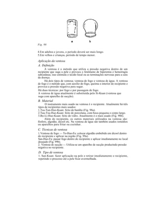 Fig. 98
4.Em adultos e jovens, o período deverá ser mais longo.
5.Em velhos e crianças, período de tempo menor.
Aplicação da ventosa
A. Definição
A ventosa é o método que utiliza a pressão negativa dentro de um
recipiente que suga a pele e provoca o fenômeno de hiperemia e hemorragia
subcutânea; isso estimula o tecido local ou as terminações nervosas para a cura
da doença.
Há dois tipos de ventosa; ventosa de fogo e ventosa de água. A ventosa
de fogo é o método que, com auxílio do fogo, queima o interior do recipiente e
provoca a pressão negativa para sugar.
Há duas técnicas: por fogo e por passagem de fogo.
A ventosa de água atualmente é substituída pelo Si-Kuan (ventosa que
suga com aparelho de sucção).
B. Material
O instrumento mais usado na ventosa é o recipiente. Atualmente há três
tipos de recipientes mais usados:
1.Tsu-Tun-Huo-Kuan: feito de bambu (Fig. 98a).
2.Tau-Tsu-Huo-Kuan: feito de porcelana, com boca pequena e corpo largo.
3.Bo-Li-Huo-Kuan: feito de vidro. Atualmente é o mais usado (Fig. 98b).
Além do recipiente, os outros materiais utilizados na ventosa são:
fósforo, algodão, álcool etc. Na ventosa de água são também usados remédios
ou aparelhos para fritar ou cozinhar.
C. Técnicas de ventosa
1. Ventosa de fogo — To-Huo-Fa: colocar algodão embebido em álcool dentro
do recipiente e aplicar na região (Fig. 99a).
San-Huo-Fa: passar fogo dentro do recipiente e aplicar imediatamente no local
desejado (Fig. 99b).
2. Ventosa de sucção — Utiliza-se um aparelho de sucção produzindo pressão
negativa no recipiente.
D. Tipo de ventosa
1. San-Kuan: fazer aplicação na pele e retirar imediatamente o recipiente,
repetindo o processo até a pele ficar avermelhada.
 
