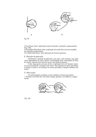 Fig. 99
2.Tsuo-Kuan: fazer a aplicação na pele mexendo o recipiente vagarosamente
(Fig. 100).
3.Chun-Hshei-Shin-Kuan: fazer a aplicação até a pele ficar com uma tonalida-
de vermelha-congestionada.
4.Ui-Hshei-Shin-Kuan: fazer aplicação até formar equimose.
E. Duração da aplicação
Geralmente a duração da aplicação é de cinco a dez minutos; mas pode
variar dependendo de outros fatores: sensibilidade local, intensidade da força
de sucção, espessura do músculo local e gravidade da doença.
Como regra geral, em caso de dor, a aplicação deve ter duração maior;
em caso de paralisia, a duração será menor. Para doenças de maior gravidade,
a duração é maior e em doenças de menor gravidade a duração também será
menor.
F. Observação
Em determinadas condições, certos cuidados se fazem necessários:
1. Paciente com febre alta, convulsão, alergia, gestante, ou tendência a sangra-
mento.
Fig. 100
 