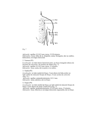 Fig. 7
Aplicação: agulhar, 0,3-0,5 tsun; moxa, 15-20 minutos.
Indicações, tosse; falta de ar, dispnéia; asma; bronquite; dor no ombro;
tuberculose; nevralgia intercostal.
2. Yunmen (P2)
Localização: no lado ântero-lateral do peito, na fossa triangular abaixo do
encontro da clavícula e do aerônio do ombro (Fig. 7).
Aplicação: agulhar, 0,3-0,5 tsun; moxa, 15 minutos.
Indicações: tosse; asma; dor no peito e no ombro.
3. Tianfu (P3)
Localização: no lado medial do braço, 3 tsun abaixo da linha axilar; no
lado radial do músculo bíceps do braço, 6 tsun acima do cotovelo
(Fig. 7). •
Aplicação: agulhar, perpendicularmente, 0,5-1 tsun.
Indicações: asma; epistaxe; dor no braço.
4. Xiapai (P4)
Localização: no lado medial do braço, no lado radial do músculo bíceps do
braço; l tsun abaixo do ponto Tianfu (P3) (Fig. 7).
Aplicação: agulhar, perpendicularmente, 0,5-0,8 tsun; moxa, 15 minutos.
Indicações: tosse; falta de ar; nevralgia intercostal; taquicardia; dor no braço.
 