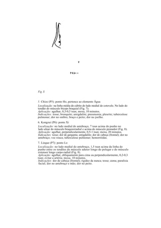 Fig. S
5. Chize (P5): ponto Ho, pertence ao elemento Água
Localização: na linha média do cúbito do lado medial do cotovelo. No lado do
tendão do músculo bíceps braquial (Fig. 7).
Aplicação: agulhar, 0,3-0,5 tsun; moxa, 10 minutos.
Indicações: tosse; bronquite; amigdalite; pneumonia; pleurite; tuberculose
pulmonar; dor no ombro, braço e peito; dor no joelho.
6. Kongzui (P6): ponto Xi
Localização: no lado medial do antebraço, 7 tsun acima do punho no
lado ulnar do músculo braquiorradial e acima do músculo pronador (Fig. 8).
Aplicação: agulhar, perpendicularmente, 0,5-1 tsun; moxa, 20 minutos.
Indicações: tosse; dor de garganta; amigdalite; dor de cabeça (frontal); dor no
antebraço; voz rouca; tuberculose pulmonar; hemorróidas.
7. Lieque (P7): ponto Lo
Localização: no lado medial do antebraço, 1,5 tsun acima da linha do
punho entre os tendões do músculo adutor longo do polegar e do músculo
extensor longo carpo-radial (Fig. 8).
Aplicação: agulhar, obliquamente para cima ou perpendicularmente, 0,2-0,3
tsun; evitar a artéria; moxa, 10 minutos.
Indicações: dor de cabeça (frontal); rigidez da nunca; tosse; asma; paralisia
facial; dor no antebraço e mão; dor no peito.
 