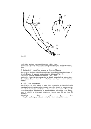 Aplicação: agulhar, perpendicularmente, 0,1-0,3 tsun.
Indicações: epistaxe; dor de dentes; amigdalite; faringite; bursite de ombro;
febre.
3. Sanjian (IG3): ponto Shu, pertence ao elemento Madeira
Localização: no lado dorsal da mão, no lado radial do segundo metacarpo, na
depressão atrás da segunda junta metacarpo-falângica (Fig. 10).
Aplicação: agulhar, perpendicularmente, 0,3-0,7 tsun.
Indicações: laringite; amigdalite; dor de dentes; trigeminalgia; dor no olho;
bursite de ombro; tendinite de cotovelo; boca seca; língua amarela; falta de
apetite.
4. Hegu (IG4): ponto Yuan
Localização: no lado dorsal da mão, entre o primeiro e o segundo osso
metacarpo no meio do primeiro músculo interósseo dorsal; ao abrir o polegar
e o dedo indicador, no meio da linha entre a junção do primeiro e do segundo
osso metacarpo, o ponto médio da borda da palma, ou quando fecha a mão,
entre o primeiro e o segundo metacarpo, o ponto mais alto em cima do
músculo
interósseo (Figs. 10 e 11).
Aplicação: agulhar, perpendicularmente, 0,5-1 tsun; moxa, 10 minutos.
Fig. 10
 