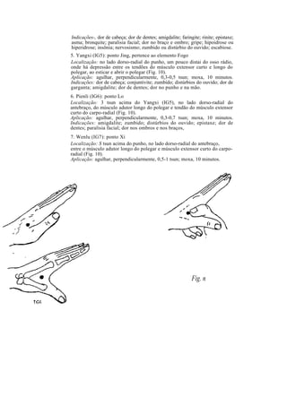 Indicações-, dor de cabeça; dor de dentes; amigdalite; faringite; rinite; epistaxe;
asma; bronquite; paralisia facial; dor no braço e ombro; gripe; hipoidrose ou
hiperidrose; insônia; nervosismo; zumbido ou distúrbio do ouvido; escabiose.
5. Yangxi (IG5): ponto Jing, pertence ao elemento Fogo
Localização: no lado dorso-radial do punho, um pouco distai do osso rádio,
onde há depressão entre os tendões do músculo extensor curto e longo do
polegar, ao esticar e abrir o polegar (Fig. 10).
Aplicação: agulhar, perpendicularmente, 0,3-0,5 tsun; moxa, 10 minutos.
Indicações: dor de cabeça; conjuntivite; zumbido; distúrbios do ouvido; dor de
garganta; amigdalite; dor de dentes; dor no punho e na mão.
6. Pienli (IG6): ponto Lo
Localização: 3 tsun acima do Yangxi (IG5), no lado dorso-radial do
antebraço, do músculo adutor longo do polegar e tendão do músculo extensor
curto do carpo-radial (Fig. 10).
Aplicação: agulhar, perpendicularmente, 0,3-0,7 tsun; moxa, 10 minutos.
Indicações: amigdalite; zumbido; distúrbios do ouvido; epistaxe; dor de
dentes; paralisia facial; dor nos ombros e nos braços,
7. Wenlu (IG7): ponto Xi
Localização: S tsun acima do punho, no lado dorso-radial do antebraço,
entre o músculo adutor longo do polegar e músculo extensor curto do carpo-
radial (Fig. 10).
Aplicação: agulhar, perpendicularmente, 0,5-1 tsun; moxa, 10 minutos.
Fig. n
 