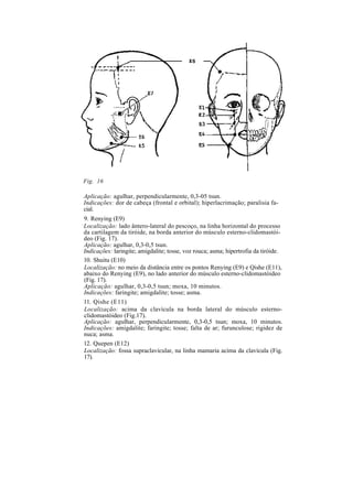 Fig. 16
Aplicação: agulhar, perpendicularmente, 0,3-05 tsun.
Indicações: dor de cabeça (frontal e orbital); hiperlacrimação; paralisia fa-
cial.
9. Renying (E9)
Localização: lado ântero-lateral do pescoço, na linha horizontal do processo
da cartilagem da tiróide, na borda anterior do músculo esterno-clidomastói-
deo (Fig. 17).
Aplicação: agulhar, 0,3-0,5 tsun.
Indicações: laringite; amigdalite; tosse, voz rouca; asma; hipertrofia da tiróide.
10. Shuitu (E10)
Localização: no meio da distância entre os pontos Renying (E9) e Qishe (E11),
abaixo do Renying (E9), no lado anterior do músculo esterno-clidomastóideo
(Fig. 17).
Aplicação: agulhar, 0,3-0,5 tsun; moxa, 10 minutos.
Indicações: faringite; amigdalite; tosse; asma.
11. Qishe (E11)
Localização: acima da clavícula na borda lateral do músculo esterno-
clidomastóideo (Fig.17).
Aplicação: agulhar, perpendicularmente, 0,3-0,5 tsun; moxa, 10 minutos.
Indicações: amigdalite; faringite; tosse; falta de ar; furunculose; rigidez de
nuca; asma.
12. Quepen (E12)
Localização: fossa supraclavicular, na linha mamaria acima da clavícula (Fig.
17).
 