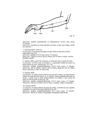Fig. 29
Aplicação: agulhar, perpendicular ou obliquamente, 0,2-0,3 tsun; moxa,
15 minutos.
Indicações: distúrbio da visão; paralisia no braço e mão; dor lombar; torsão
no tornozelo.
7. Zhizheng (ID7): ponto Lo
Localização: 5 tsun acima do punho, no lado ulnar do músculo extensor
carpo-ulnar (Fig. 29).
Aplicação: agulhar 0,3-0,8 tsun; moxa, 15 minutos.
Indicações: rigidez na nuca; dor de cabeça; dor no braço e dedos; tontura;
distúrbio mental.
8. Xiaohai (ID8): ponto Ho, pertence ao elemento Terra; ponto de Filho
Localização: na fossa entre o olecrânio e o epicôndilo medial do úmero na
borda lateral do nervo radial (Figs. 29 e 30).
Aplicação: agulhar, perpendicularmente, 0,2-0,3 tsun; moxa, 15 minutos.
Indicações: dor de cabeça; tontura; dor de dentes; gengivite; dor no ombro,
braço, antebraço e mão, no lado ulnar.
9. Jianzhen (ID9)
Localização: na região póstero-inferior da junta dos ombros, no lado póstero-
inferior do músculo teres maior; ao se colocar o braço perpendicularmente ao
tronco, o ponto fica no lado póstero-inferior do ombro, l tsun acima do
ponto no fim da linha axilar (Fig. 30).
Aplicação: agulhar, perpendicularmente, 0,5-1,5 tsun; moxa, 15 minutos.
Indicações: bursite no ombro; dor no braço; zumbido; surdez; braquialgia.
10. Naoshu (ID10)
Localização: no lado posterior da junta do ombro, na borda do osso espinha-
escapular, em cima do músculo deltóide (Fig. 30).
Aplicação: agulhar, perpendicularmente, 0,5-1 tsun; moxa, 15 minutos.
Indicações: bursite no ombro; -braquialgia; hemiplegia; hipertensão.
 