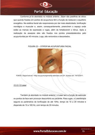 AN02FREV001/REV 4.0
73
Conforme já foi abordado no módulo anterior, Stiper são pastilhas de silício
que quando fixadas em pontos de acupuntura têm a função de restaurar o equilíbrio
energético. Na estética facial são responsáveis por dar mais elasticidade, tonificação
nevrálgica e muscular e, assim, consequentemente, preenchem o espaço onde
estão as marcas de expressão e rugas, além de fortalecerem o tônus. Após a
realização da assepsia eles são fixados nos pontos preestabelecidos pelo
acupunturista por 40 minutos. Logo, são removidos e descartados.
FIGURA 23 – STIPER NA ACUPUNTURA FACIAL
FONTE: Disponível em: <http://acupunturapimenta.webnode.com.br>. Acesso em: 14/12/2011.
3.3.3.1.2 Laser
Também já abordado no módulo anterior, o Laser tem a função de estimular
os pontos da face sem provocar desconforto ao paciente. Para rugas, a Laserterapia
seguirá os parâmetros de tonificação de até 10Hz, tempo de 10 a 20 minutos e
dispersão de 10 a 160 Hz, com tempo de 30 minutos.
 