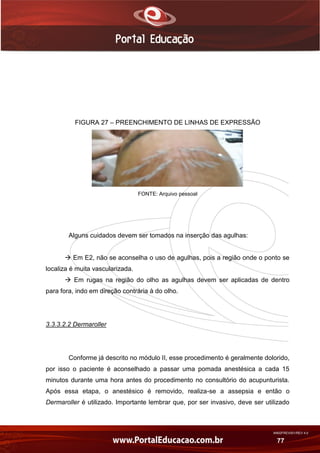 AN02FREV001/REV 4.0
77
FIGURA 27 – PREENCHIMENTO DE LINHAS DE EXPRESSÃO
FONTE: Arquivo pessoal
Alguns cuidados devem ser tomados na inserção das agulhas:
 Em E2, não se aconselha o uso de agulhas, pois a região onde o ponto se
localiza é muita vascularizada.
 Em rugas na região do olho as agulhas devem ser aplicadas de dentro
para fora, indo em direção contrária à do olho.
3.3.3.2.2 Dermaroller
Conforme já descrito no módulo II, esse procedimento é geralmente dolorido,
por isso o paciente é aconselhado a passar uma pomada anestésica a cada 15
minutos durante uma hora antes do procedimento no consultório do acupunturista.
Após essa etapa, o anestésico é removido, realiza-se a assepsia e então o
Dermaroller é utilizado. Importante lembrar que, por ser invasivo, deve ser utilizado
 