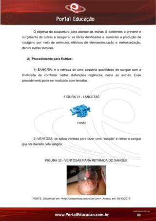 AN02FREV001/REV 4.0
88
O objetivo da acupuntura para atenuar as estrias já existentes e prevenir o
surgimento de outras é recuperar as fibras danificadas e aumentar a produção de
colágeno por meio de estímulos elétricos de eletroestimulação e eletrossedação,
dentre outras técnicas.
A) Procedimento para Estrias:
1) SANGRIA: é a retirada de uma pequena quantidade de sangue com a
finalidade de combater certas disfunções orgânicas, neste as estrias. Esse
procedimento pode ser realizado com lancetas.
FIGURA 31 - LANCETAS
FONTE
2) VENTOSA: se aplica ventosa para fazer uma “sucção” e retirar o sangue
que foi liberado pela sangria.
FIGURA 32 - VENTOSAS PARA RETIRADA DO SANGUE
FONTE: Disponível em: <http://dravanessa.webnode.com>. Acesso em: 06/10/2011.
 