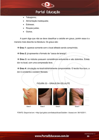 AN02FREV001/REV 4.0
90
 Tabagismo;
 Alimentação inadequada;
 Estresse;
 Roupas justas;
 Outros.
A quem diga que não se deve classificar a celulite em graus, porém essa é a
maneira mais descrita na literatura. Os graus são:
 Grau 1: aparece somente com o local afetado sendo comprimido;
 Grau 2: já apresenta o formato de “casca de laranja”;
 Grau 3: os nódulos possuem consistência endurecida e são doloridos. Existe
dor no local, com uma compressão leve.
 Grau 4: circulação no local extremamente comprometida. O tecido fica duro, a
dor é constante e existem fibroses.
FIGURA 33 – GRAUS DA CELULITE
FONTE: Disponível em: <http://gnt.globo.com/beleza/dicas/Celulite>. Acesso em: 06/10/2011.
 