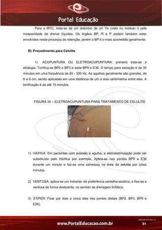AN02FREV001/REV 4.0
91
Para a MTC, trata-se de um distúrbio de Jin Ye (visto no módulo I) pela
incapacidade de drenar líquidos. Os órgãos BP, R e P podem também estar
envolvidos neste processo de retenção, porém o BP é o mais acometido geralmente.
B) Procedimento para Celulite
1) ACUPUNTURA OU ELETROACUPUNTURA: primeiro trata-se a
etiologia. Tonifica-se BP2 e BP3 e seda BP9 e E36. O tempo para sedação é de 30
minutos em uma frequência de 50 - 300 Hz. As agulhas geralmente são grandes, de
6 a 8 cm, sendo aplicadas em uma distância de um a dois centímetros entre elas. A
tonificação é de até 15 minutos.
FIGURA 34 – ELETROACUPUNTURA PARA TRATAMENTO DE CELULITE
1) HAIHUA: Em pacientes com aversão à agulha, a eletroestimulação pode ser
substituída pelo HaiHua por exemplo. Aplica-se nos pontos BP9 e E36
durante um minuto e faz-se uma varredura na área da celulite por cinco
minutos.
2) VENTOSA: aplica-se um hidrante, de preferência centelha-asiática, e fixa-se a
ventosa de forma deslizante, no sentido de drenagem linfática.
3) STIPER: Fixar por dois a cinco dias nos pontos distais (BP2, BP3, BP9 e
E36).
 
